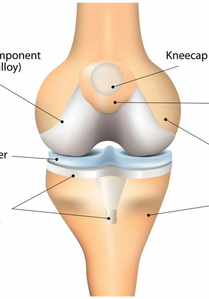 knee replacement parts