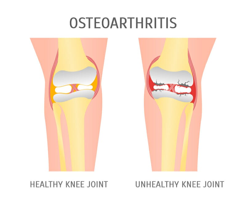 hl_exercises-osteoarthritis_2